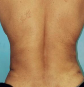 After MicroTight™ results - front view