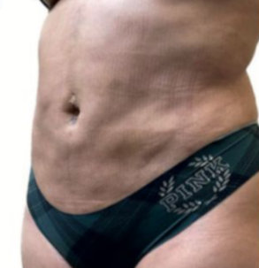 After MicroTight™ results - side view