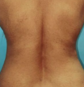 Before MicroTight™ results - front view