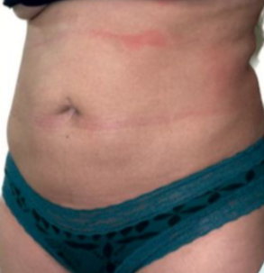 Before MicroTight™ results - side view